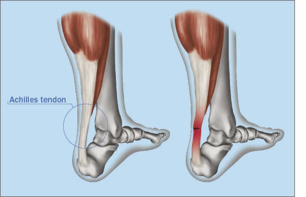 Achilles Graphic
